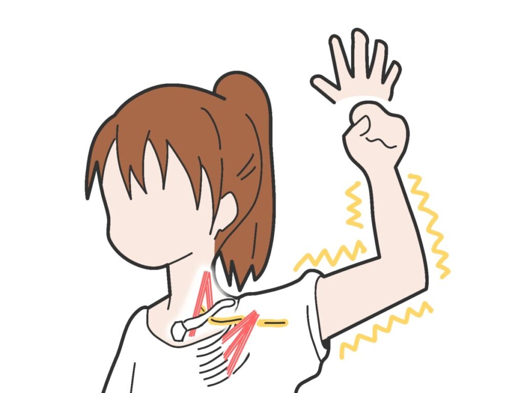 胸郭出口症候群