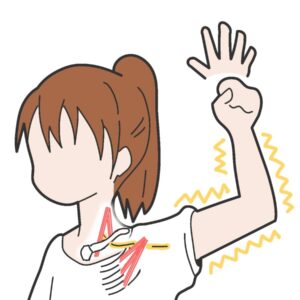 胸郭出口症候群